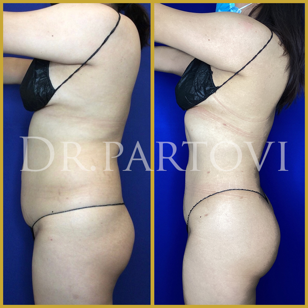 Brazilian Butt Lift (BBL) – Verve Plastic Surgery