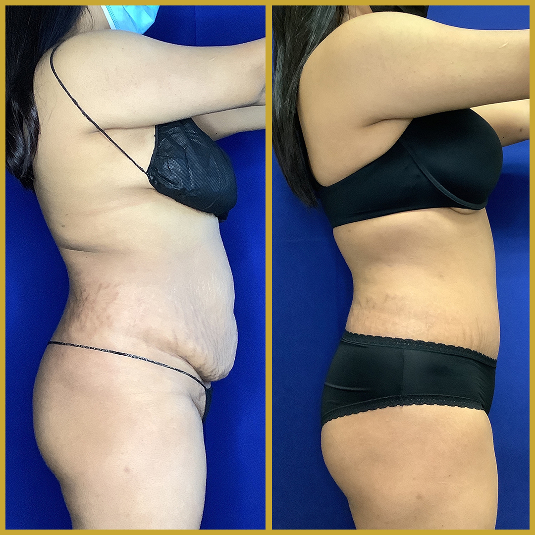 How To Spot Best Tummy Tuck Results in Before and After Photos