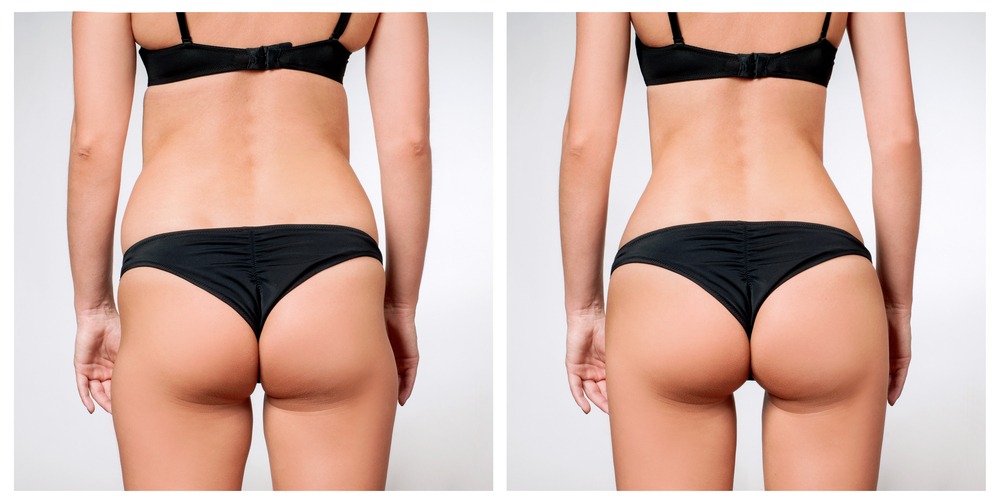NON-SURGICAL BUTT-LIFT WITH SCULPTRA AND RADIESSE, Before & After